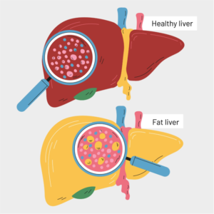 Liver Function Test : Everything You Need to Know About It