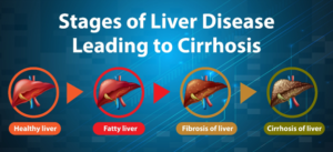 Liver Function Test : Everything You Need to Know About It
